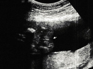 Ecografía sexo bebé femenino
