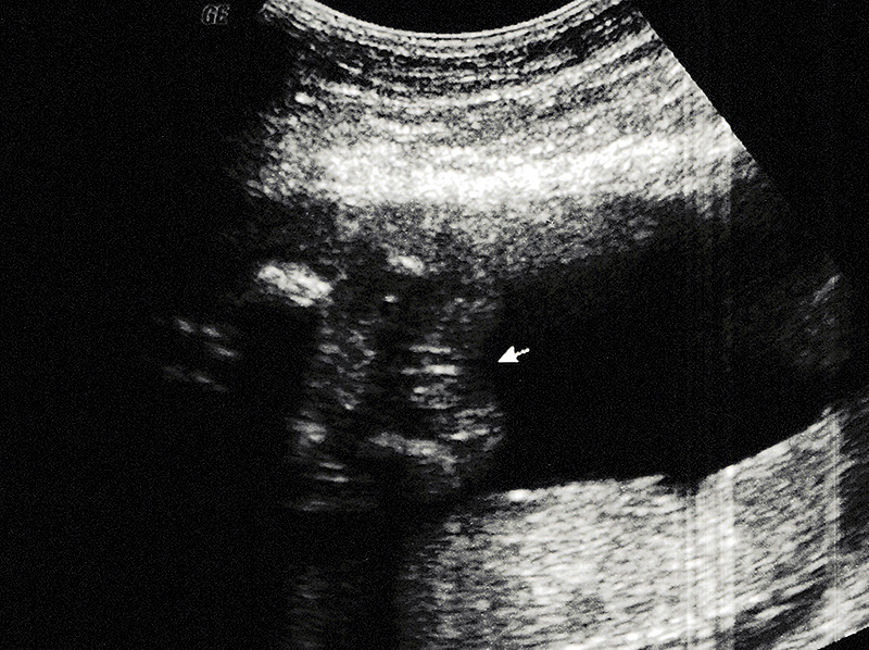 Ecografía sexo bebé femenino